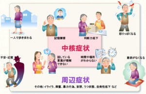 アルツハイマー認知症